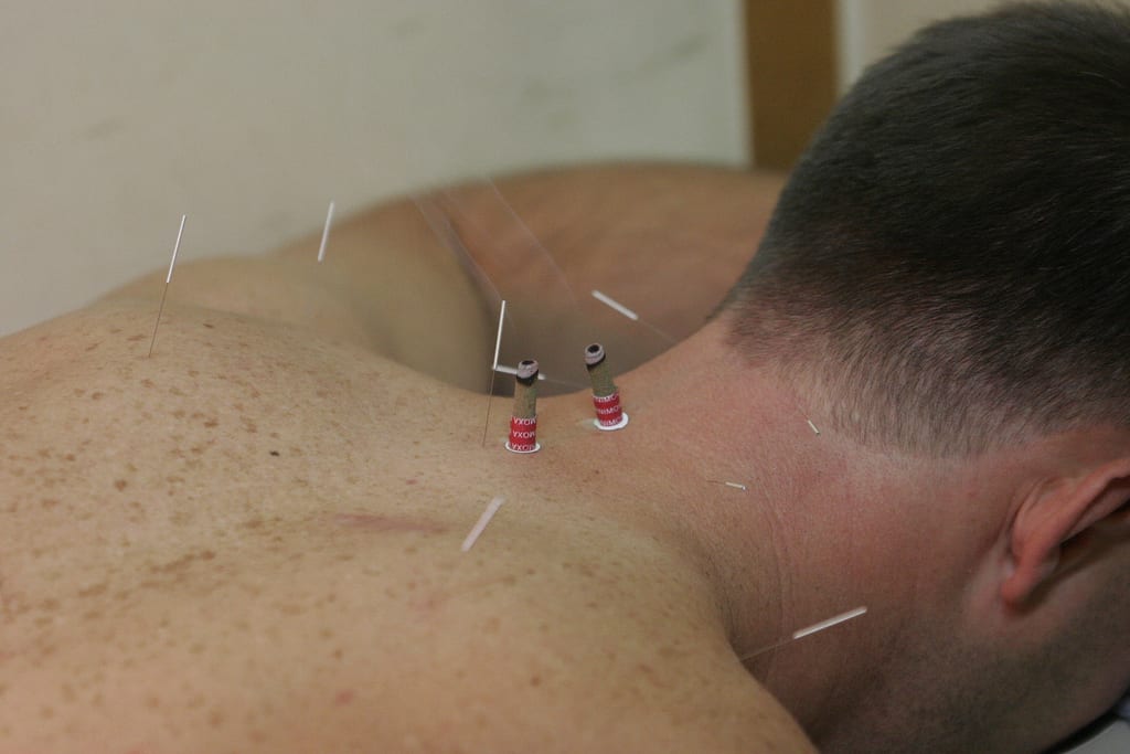 Acupuncture for chronic pain