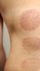 Cupping - What is it and how does it help?